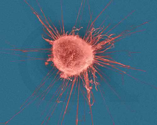 breast cancer cell